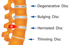 Image result for degenerative disc disease